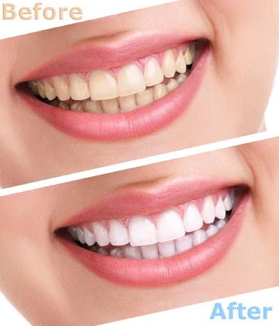 before and after look at teeth whitening services provided by Roseville Dental Company in Roseville, CA